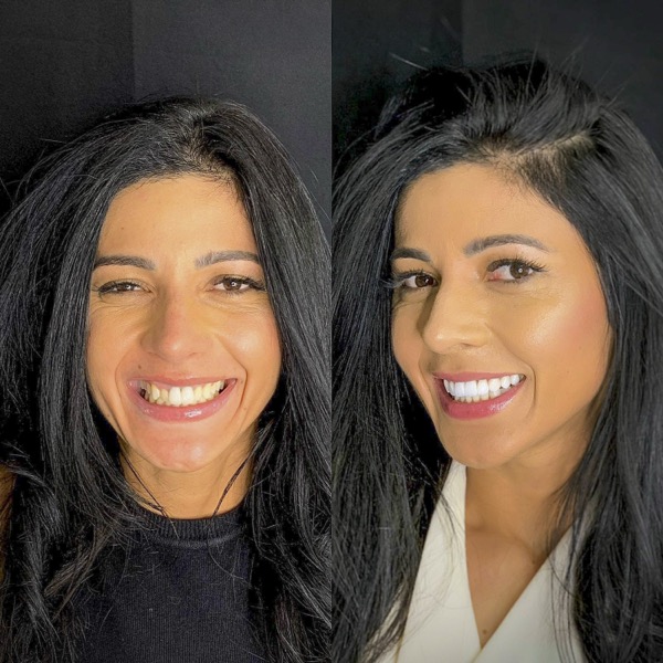 Antes e depois de tratamento dental na Clínica Benvenutti