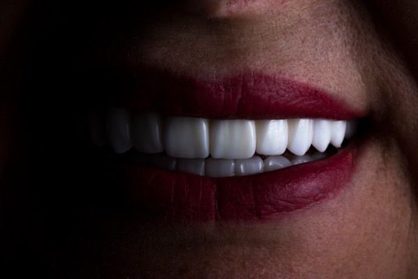 Lentes de contato dental na Clínica Benvenutti